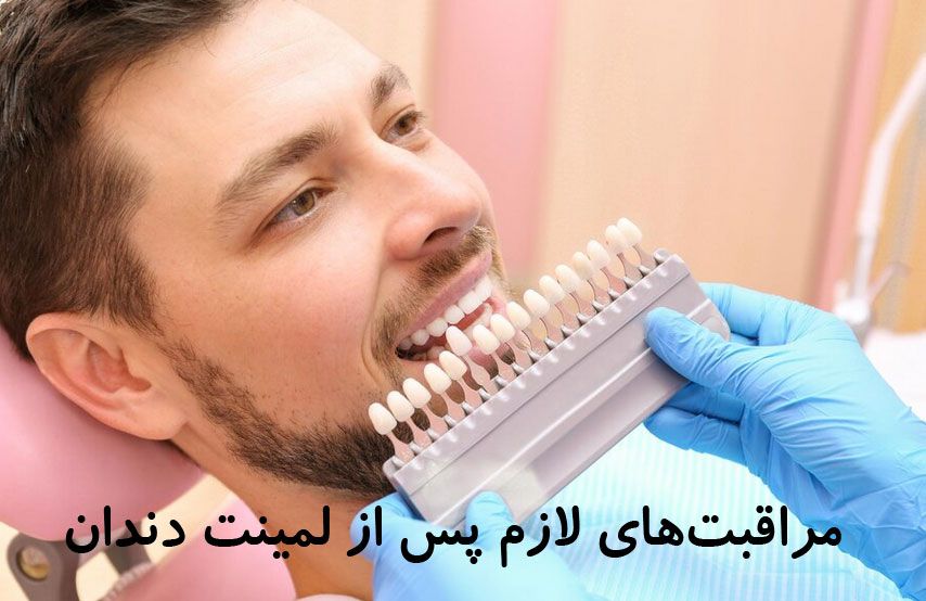 مراقبت‌های لازم پس از لمینت دندان