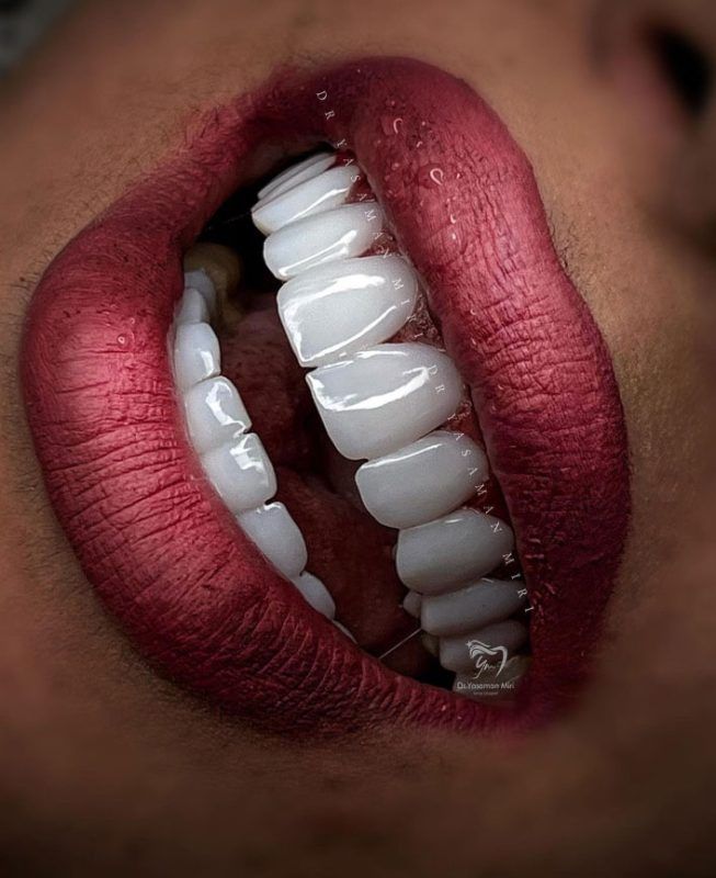 تأثیر کامپوزیت دندان بر زیبایی و اعتماد به نفس افراد