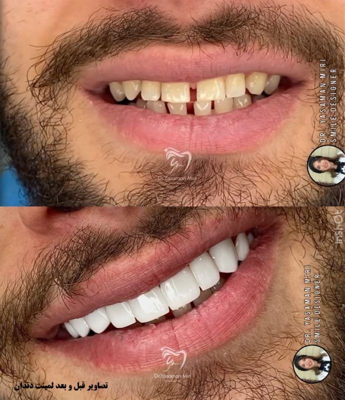 قبل-و-بعد-لمینت-دندان