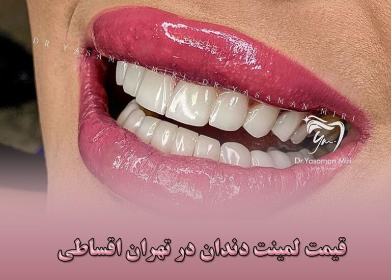 قیمت-لمینت-دندان