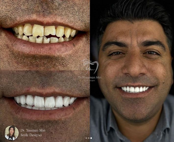 کامپوزیت-دندان دکتر یاسمن میری