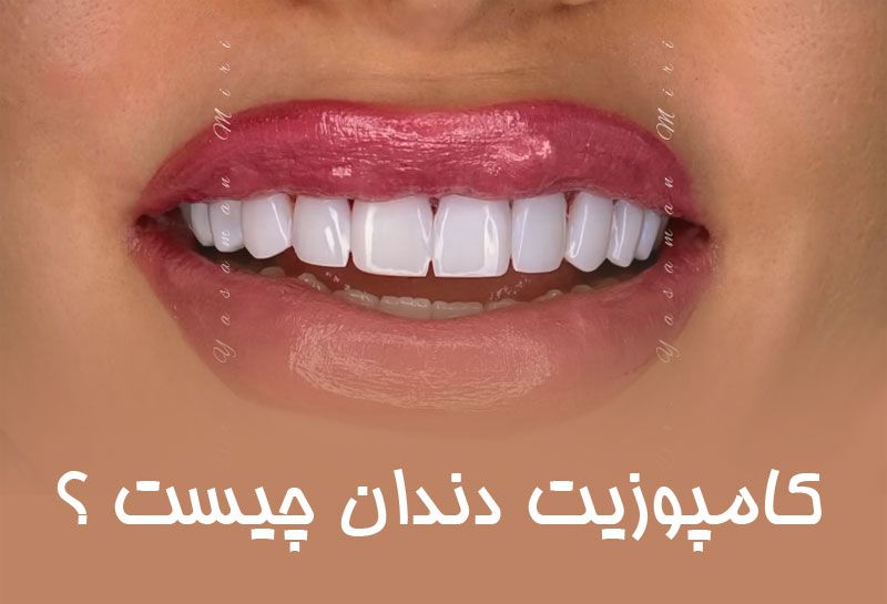 کامپوزیت دندان چیست ؟