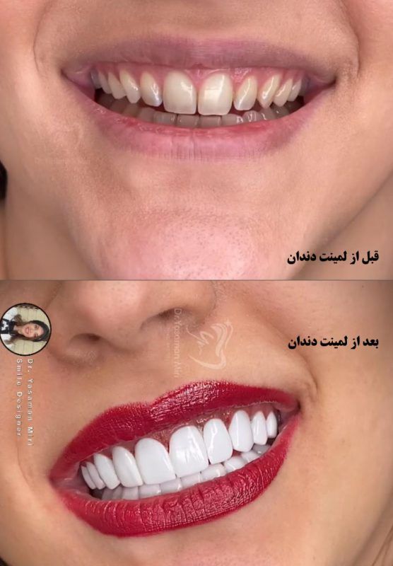 قبل و بعد ازبهترین  لمینت دندان