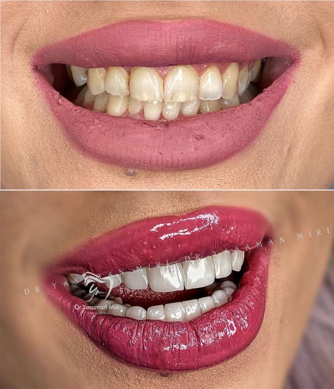 نمونه-کار-لمینت-دندان