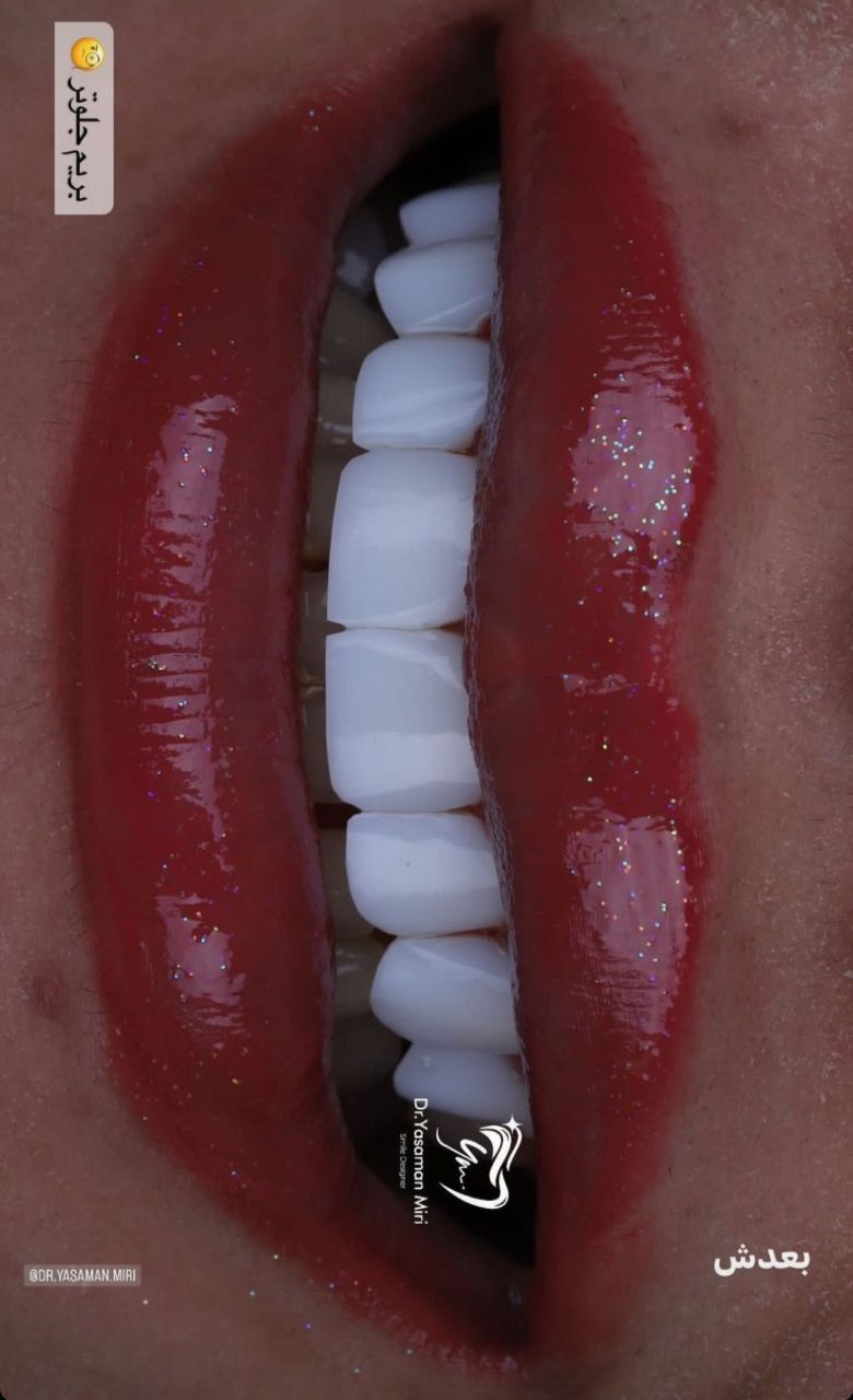 نمونه دندان کامپوزیت شده