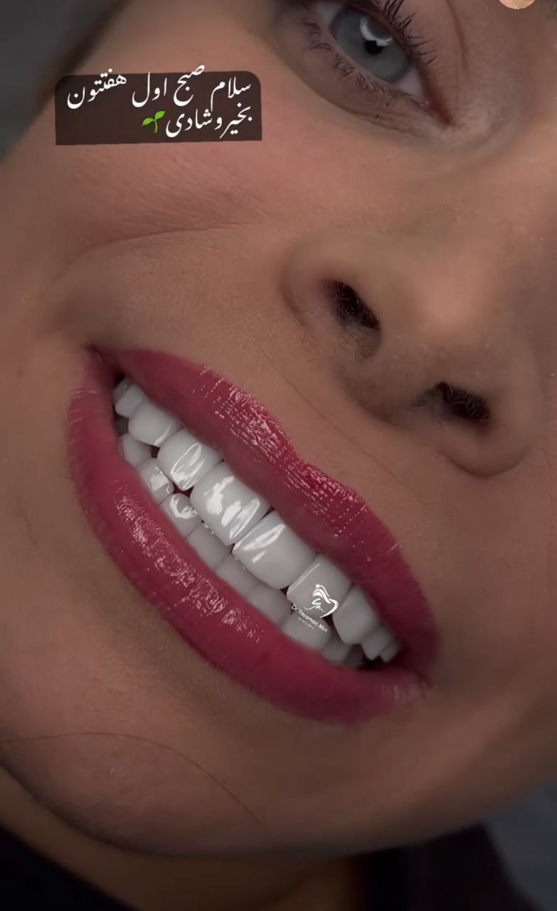 نمونه دندان های کامپوزیت شده