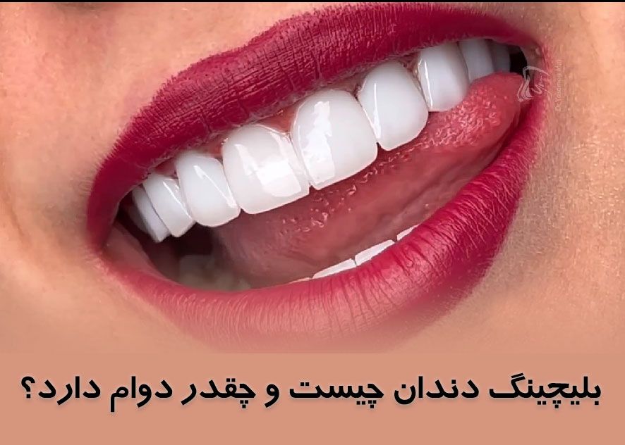 بلیچینگ-دندان