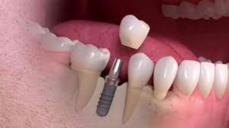 طول درمان ایمپلنت دندان
