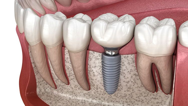 طول درمان ایمپلنت دندان