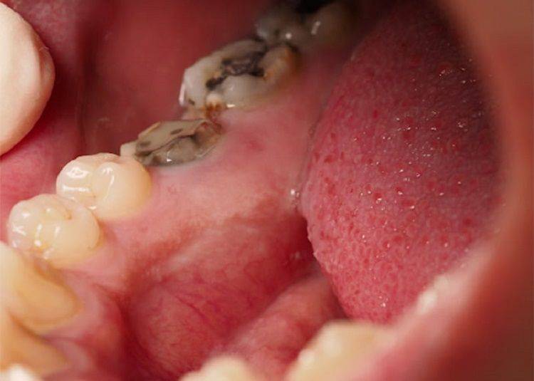 پوسیدگی دندان