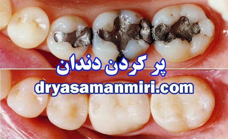 پر کردن دندان