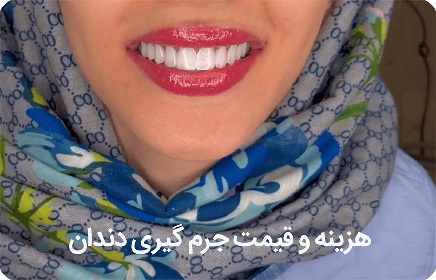 جرم-گیری-دندان