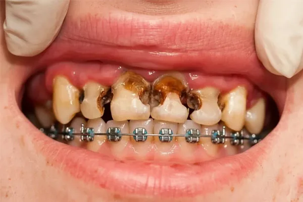 درمان پوسیدگی دندان