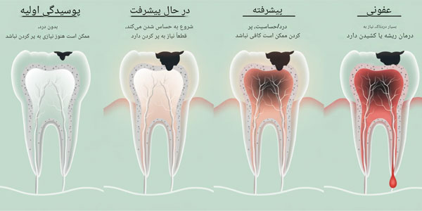 مسکن قوی دندان درد خانگی