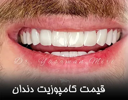 قیمت-کامپوزیت-دندان