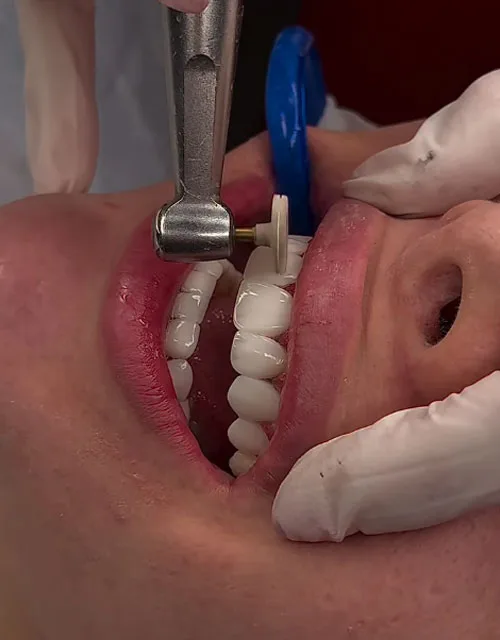 نمونه-کار کامپوزیت -دکتر-میری