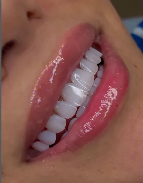 نمونه-کار کامپوزیت -دکتر-میری